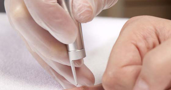 Điều trị mụn cóc, thịt dư nhiều bằng công nghệ Lazer