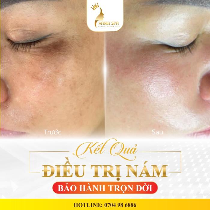 TRỊ NÁM DA BÔI KEM CÓ HẾT KHÔNG ?