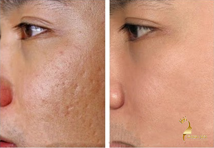 Lắp đầy sẹo rỗ, tái tạo làn da bằng phương pháp bóc tách dáy sẹo và lăn kim