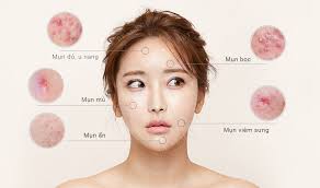 Mụn là gì? Nguyên nhân, triệu chứng và cách điều trị.