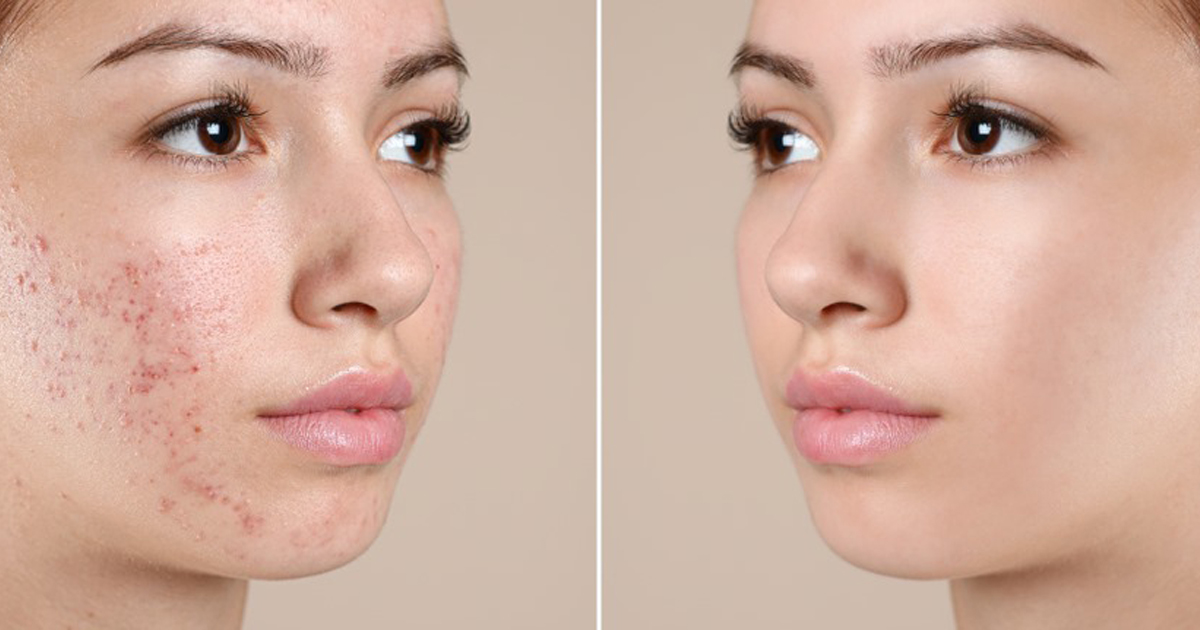 Trị mụn chuyên sâu chuẩn y khoa