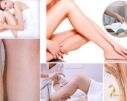 Triệt lông vĩnh viễn