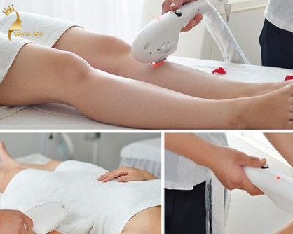 Triệt lông vĩnh viễn