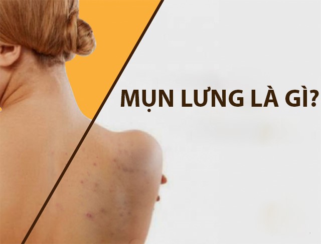 MỤN LỰNG – NGUYÊN NHÂN HÌNH THÀNH – BIỆN PHÁP PHỤC HỒI