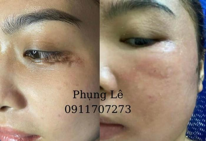 REVIEW KẾT QUẢ ĐIỀU TRỊ SẸO NẶNG MÍ MẮT