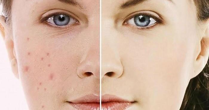 Trị thâm sau mụn Vania Spa bằng công nghệ Lazer